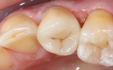Fig. 13: Vista occlusale sulla corona endodontica fissata con tecnica adesiva.