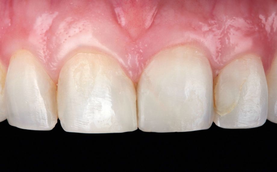 Fig. 2: Il settore frontale superiore riabilitato in composito risulta senza vita e innaturale.