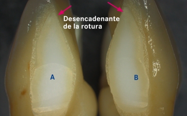 Fig. 1a: Por motivos estéticos, tras la sinterización se separó la estructura entre los dientes 31 y 41.
