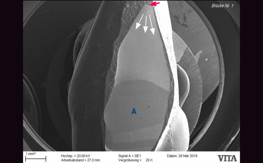 Fig. 1b: La formación de fisuras, que finalmente condujo a la fractura, partió de la estructura de soporte dañada en la zona incisal.