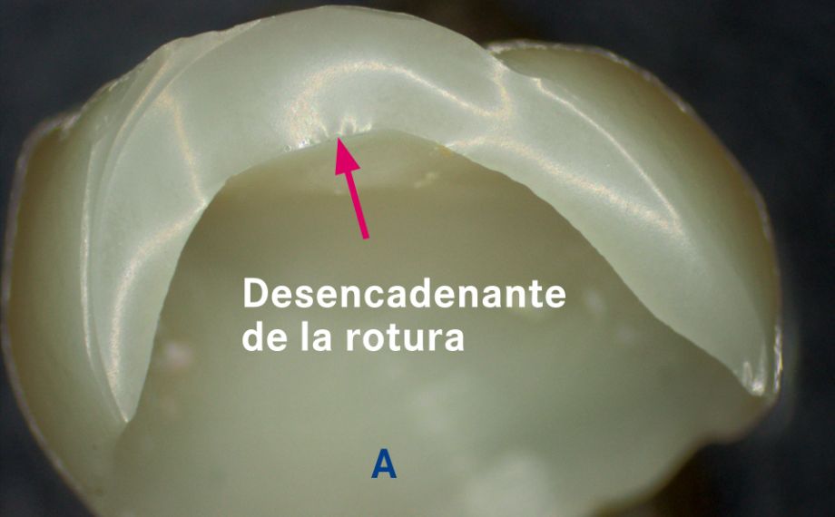 Fig. 2a: Corona de cerámica vítrea fracturada tras la cocción de glaseado.