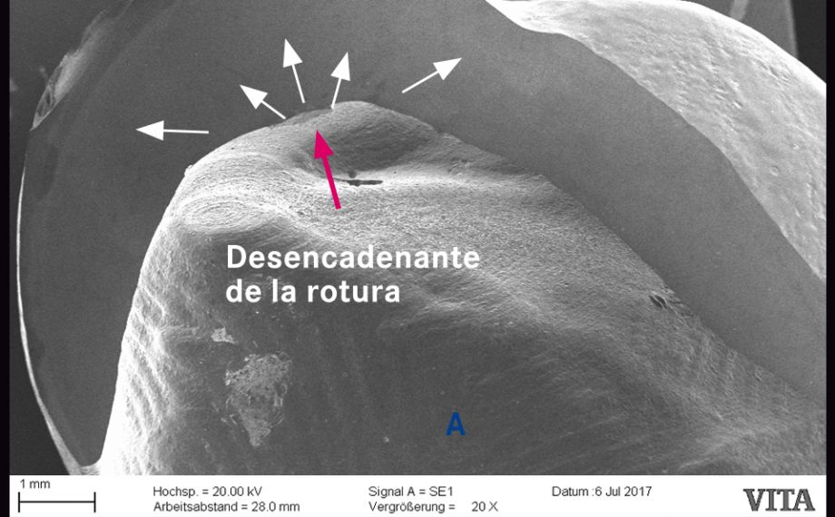 Fig. 2b: Una espiga de cerámica “sinterizada” con la corona provocó un daño superficial al retirar la restauración.