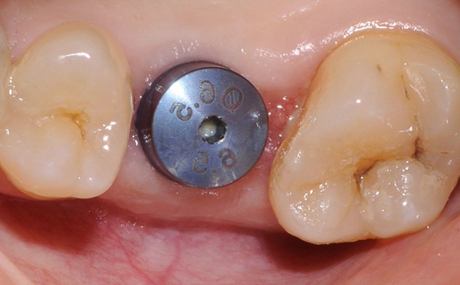 Fig. 1: Situación de partida: El implante en el diente 26 tras un periodo de cicatrización de tres meses.