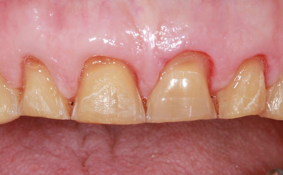 Fig. 5: Tras la estabilización protésica de la zona de los dientes posteriores, se llevó a cabo la preparación de mock-up.