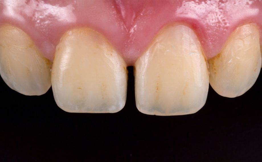 Fig. 1: Situación de partida: Paciente joven con diastema entre los dientes 11 y 21.