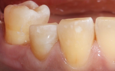 Fig. 4: Únicamente se acortaron por oclusal las paredes remanentes de la cavidad.