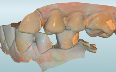 Fig. 6: Mediante un escaneo vestibular se trasladó la intercuspidación habitual.
