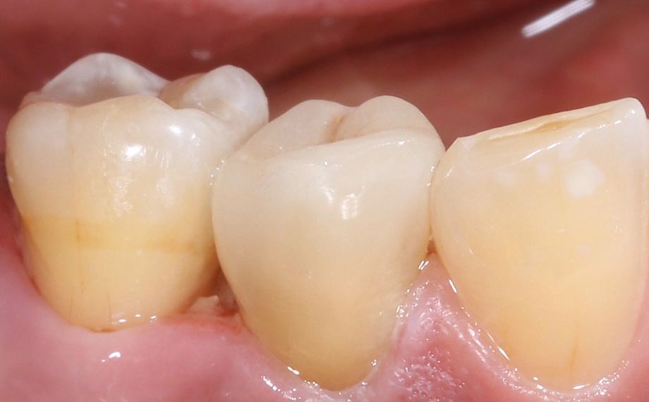 Fig. 12: Desde vestibular no se observaban transiciones entre la restauración y el diente.