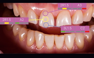 Fig. 5: Antes de la preparación se determinó con precisión y rapidez el color dental básico mediante el VITA Easyshade V.