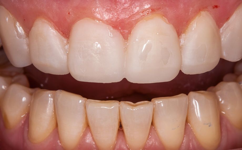 Fig. 6: El modelo de mock-up se trasladó intraoralmente mediante una llave de silicona y composite provisional.