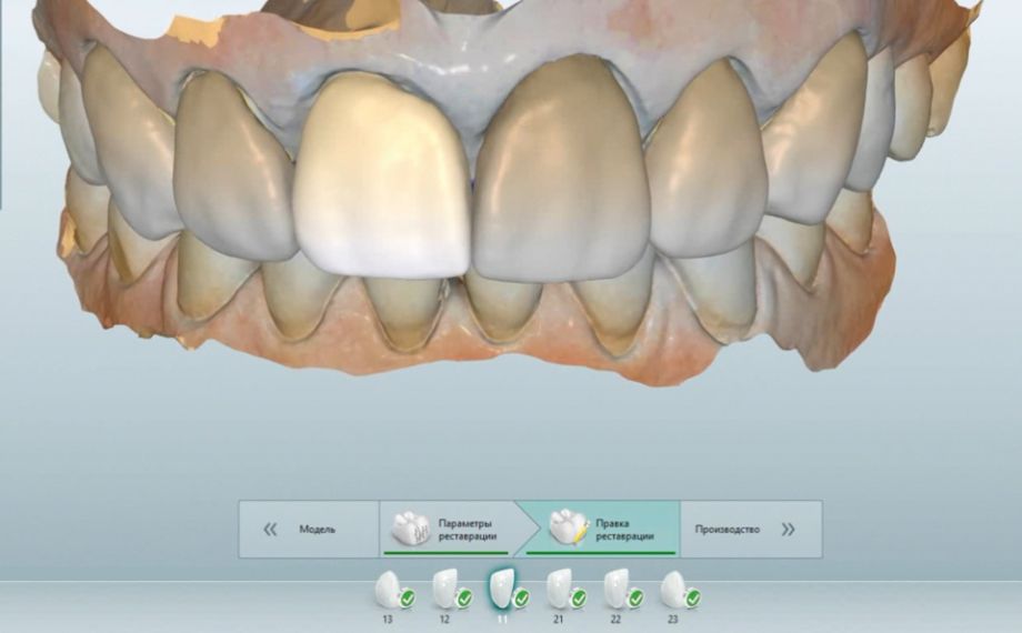 Fig. 7: El mock-up intraoral se escaneó con el sistema MyCrown.