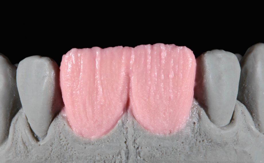 Fig. 5: El núcleo de dentina se estratificó con BASE DENTINE A2.