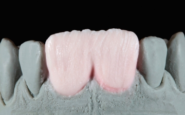Fig. 6: Posteriormente se modificó el núcleo de dentina con TRANSPA DENTINE.