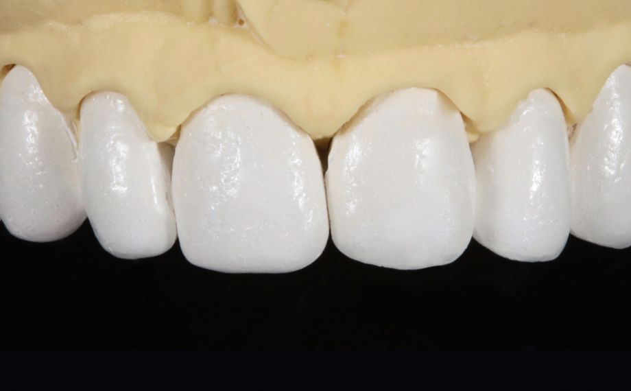 Fig. 3: El modelo maestro con muñones pirorresistentes y las carillas reducidas anatómicamente tras la cocción de dentina.