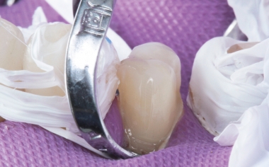 Fig. 11: La preparación mínimamente invasiva acondicionada en el diente 14.