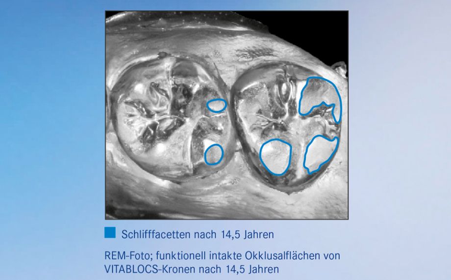 Grafik 2a/b: In Untersuchungen zeigten Restaurationen aus VITABLOCS ein naturähnliches Abrasionsverhalten.Quelle: Externe Untersuchung 2016, Universität Zürich/Praxis am Zürichberg, Epoxymodell von Abdruck nach 14,5 Jahren mit Gold bedampft, S/W-Fotografie des Modells (PD Dr. Andreas Bindl)