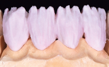 Abb. 3: Die Basisschichtung des Dentinanteils erfolgte mit DENTINE A3.