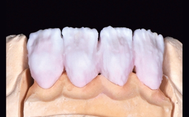 Abb. 7: Vor dem ersten Dentinbrand wurde noch die Schmelzmasse ENAMEL light addiert.