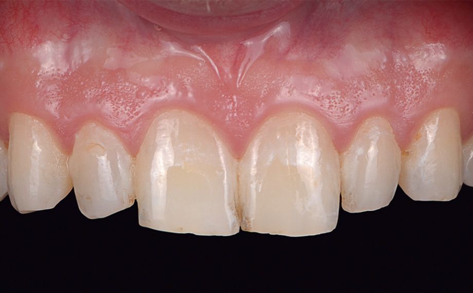 Abb. 2: Die Zahnfarbe und Whitespots störten den Patienten.