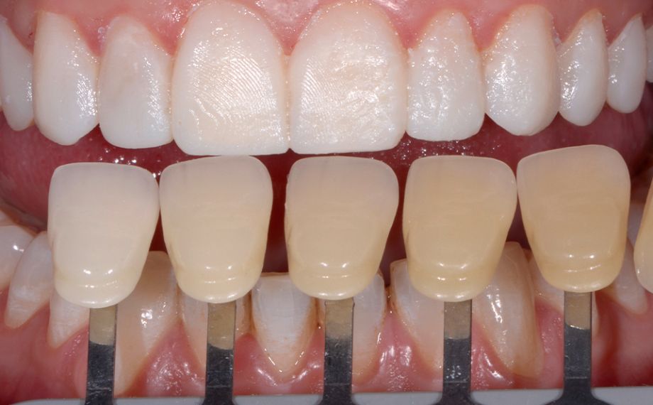 Abb. 6: Die Zahnfarbbestimmung erfolgte mit dem VITA SYSTEM 3D-MASTER.