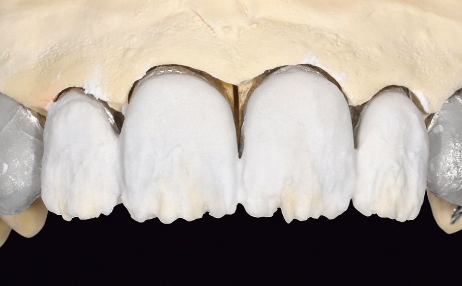 Abb. 12: Der Dentinanteil wurde aus LUMINARY 1 (weiß) und DENTINE 1M1 geschichtet.