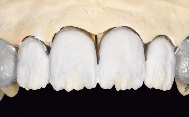 Abb. 12: Der Dentinanteil wurde aus LUMINARY 1 (weiß) und DENTINE 1M1 geschichtet.