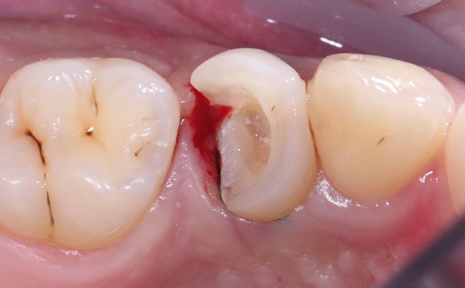 Abb. 2: Nach der Entfernung der alten Kompositfüllung zeigte sich am approximalen Kasten eine entzündliche Blutung der Gingiva.