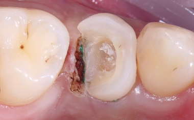 Abb. 3: Um die Blutung zu stillen und alle Areale optisch erfassbar zu machen, wurde distal gingivektomiert und ein Retraktionsfaden eingelegt.