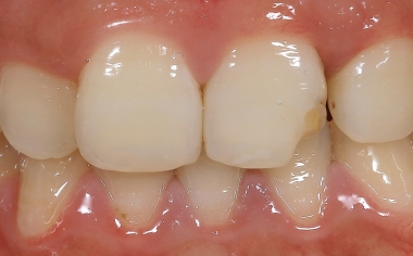 Abb. 1: Die Ausgangssituation mit dem frakturierten Zahn 21 bei der Erstvorstellung in der Zahnarztpraxis.