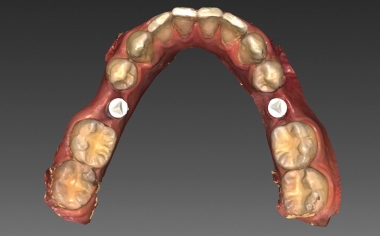 Abb. 3: Die gescannte intraorale Situation im Unterkiefer in der InLab-CAD-Software.
