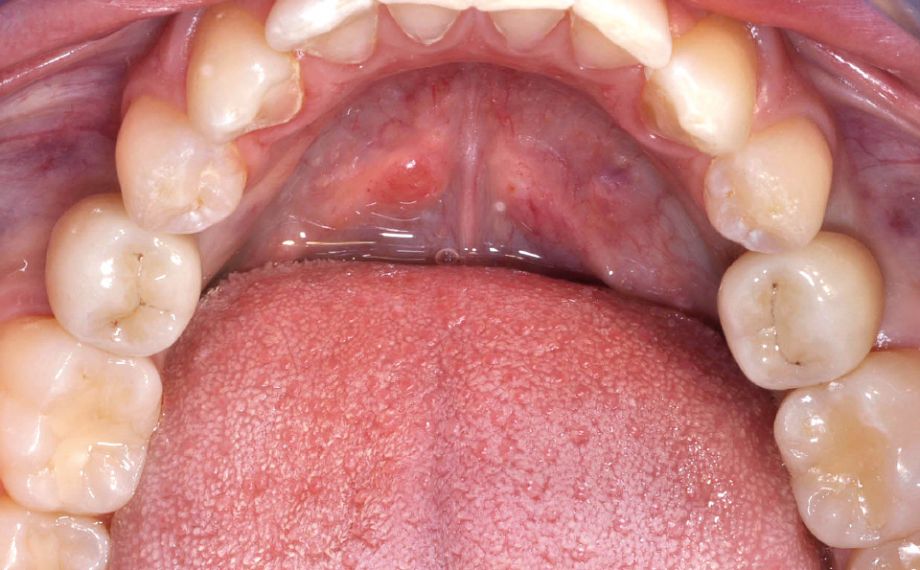 Abb. 12, Ergebnis: Beide implantatprothetischen Versorgungen integrierten sich harmonisch in den natürlichen Zahnbogen.