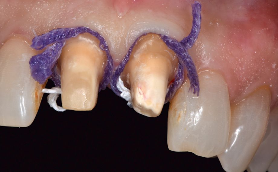 Abb. 3: Die Gingiva wurde mit Fäden und Teflon retrahiert, um bei der Abformung alle relevanten Bereiche zu erfassen.