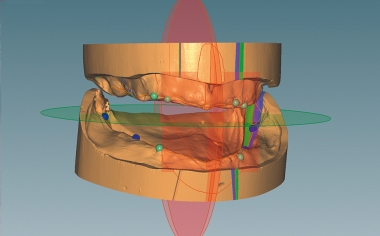 Abb. 3: Die CAD-Software Ceramill Mind führte durch die virtuelle Modellanalyse nach TiF®.