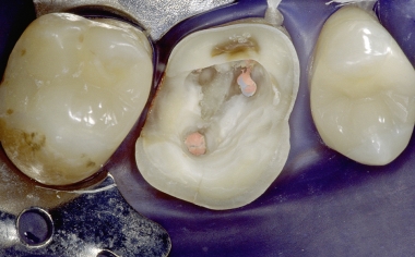 Fig. 1a Endocrown preparation with reduced retention and primarily adhesive bond in less favorable dentin.