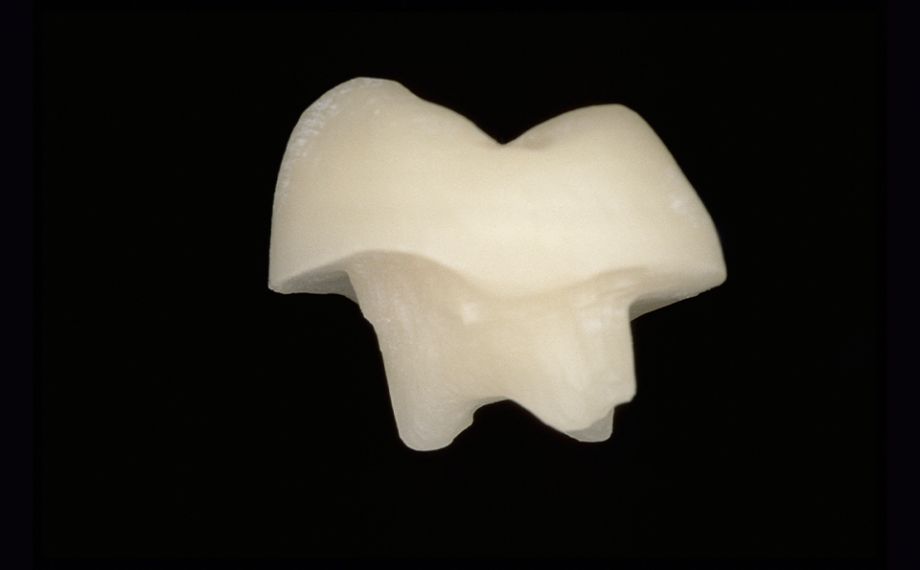 Fig. 1c The CAD/CAM-supported finished endocrown after finishing and polishing.