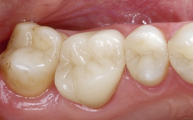 Fig. 1d The clinical baseline situation directly after the full-adhesive cementation.