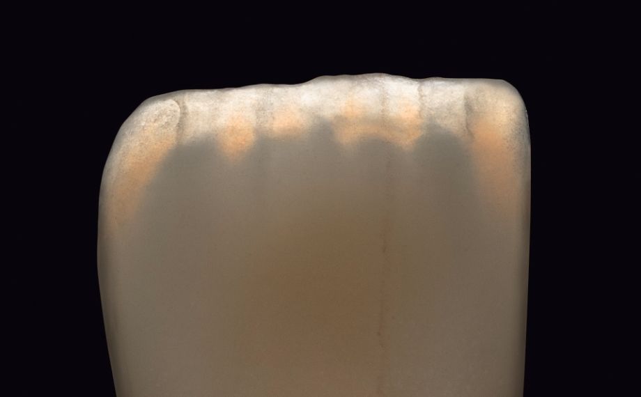 1a Opalescence
Fig 1a-c Documentation of the photo-optic properties of VITA LUMEX AC shown by photographing sample crowns using different lighting conditions and sources.