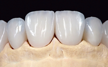 Fig. 7 The absolutely natural appearance of the six veneers was already visible in the master model.