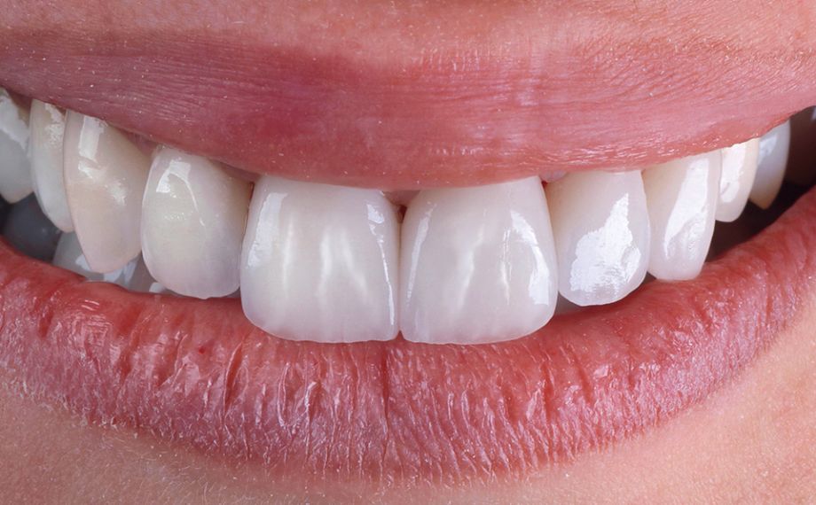 RESULTS A highly esthetic smile was created with ease.