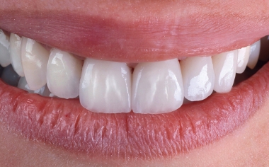 RESULTS A highly esthetic smile was created with ease.