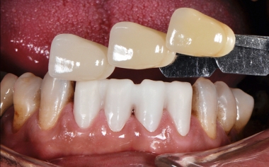 INITIAL SITUATION Framework try-in and tooth shade determination using the VITA shade guide.