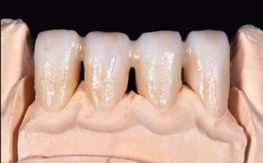 Fig. 2 The washbake is done with FLUO INTENSE sand and the incisal with sesame.