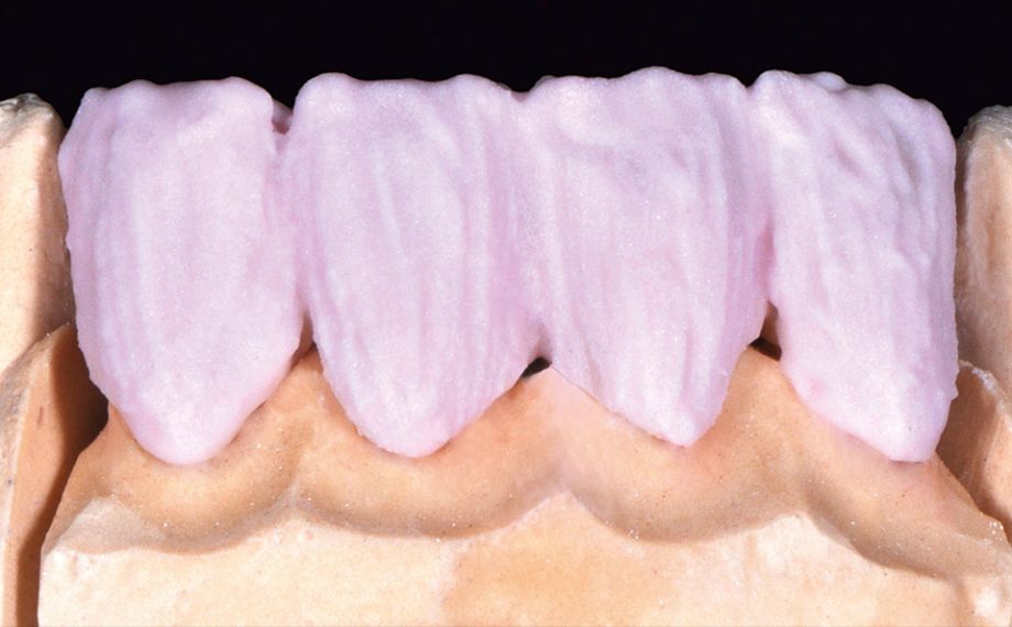 Fig. 5 The intensification of the cervical margin was performed laterally with A3.5, in combination with some FLUO INTENSE sand.