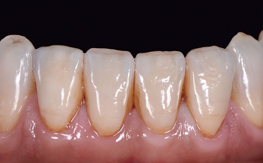 RESULTS A highly esthetic result was achieved using VITA LUMEX AC.