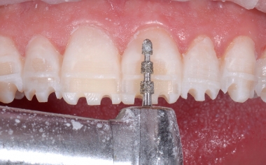 Fig. 8 A controlled mock-up preparation allowed for a minimally invasive procedure.