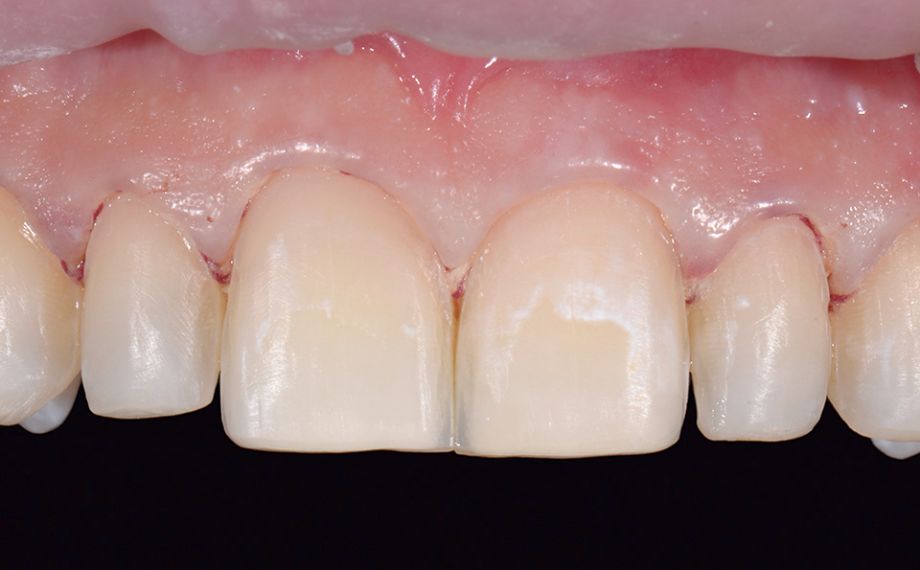 Fig. 9 The clinical situation after minimal tooth substance removal and with slight tapering.