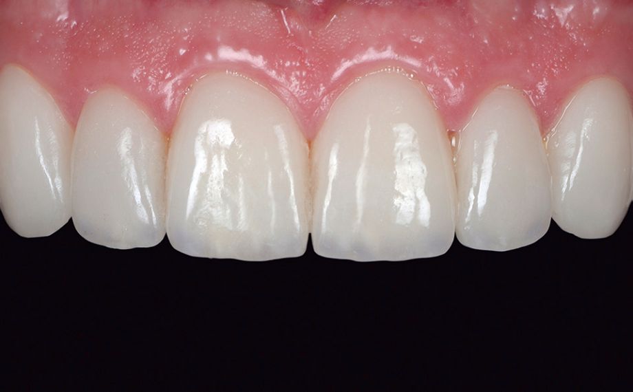 Fig. 15 The clinical situation after six weeks. The papillae showed complete regeneration.