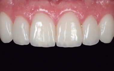 Fig. 15 The clinical situation after six weeks. The papillae showed complete regeneration.