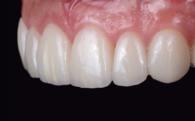Fig. 16 The veneers showed a highly esthetic appearance in terms of shape and color.