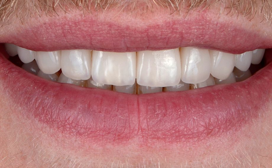 RESULT The patient was delighted with his new smile. The lips and incisal edges harmonized with each other.